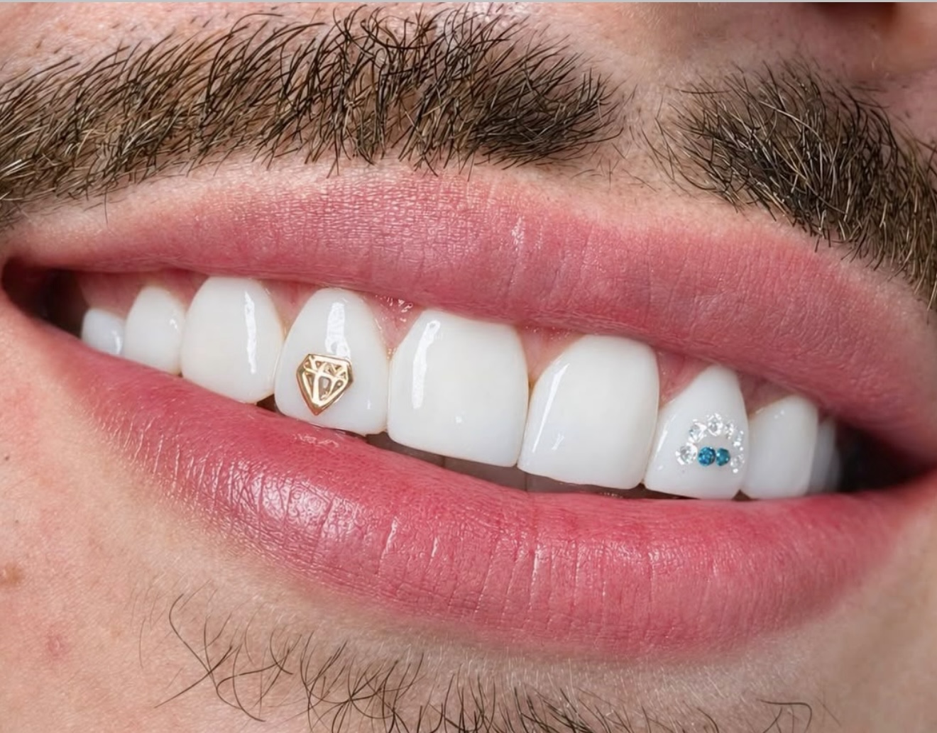 Microdiseño con joyas dentales en oro